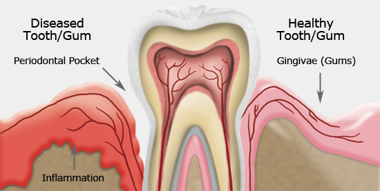 gum_disease_illustration